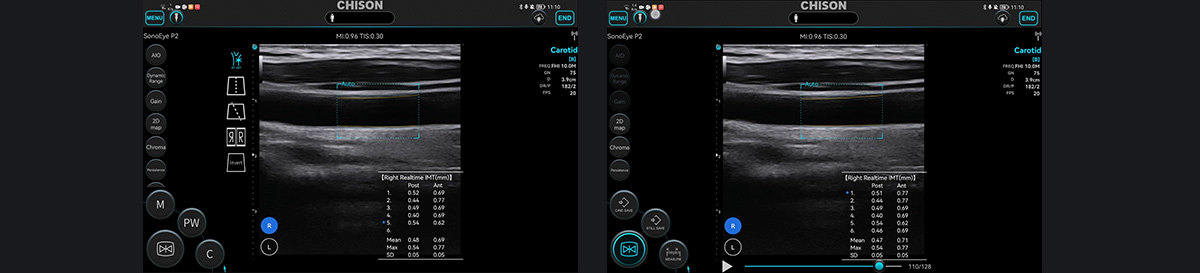 SonoEye ��Ѫ�ܳ����е�Ӧ��