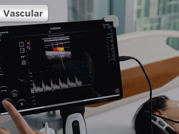 SonoEye ��Ѫ�ܳ����е�Ӧ��