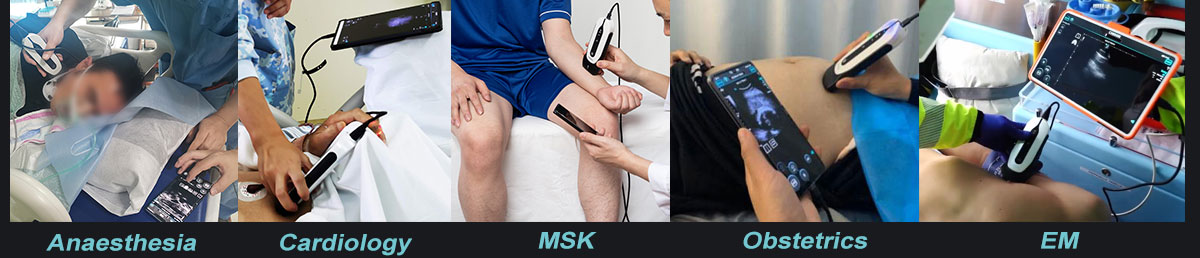 The Point-of-Care Ultrasound (POCUS) Revolution