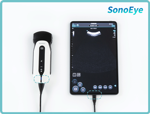 Mastering SonoEye: A Beginner's Guide to Portable Handheld Ultrasound for Clinical Efficiency